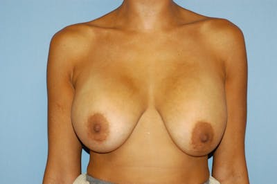 Breast Revision Before & After Gallery - Patient 6389731 - Image 1