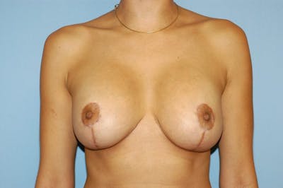 Breast Revision Before & After Gallery - Patient 6389731 - Image 2