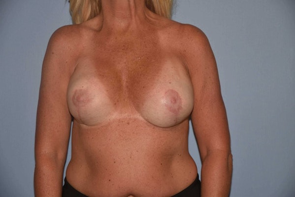 Breast Revision Before & After Gallery - Patient 6389739 - Image 2