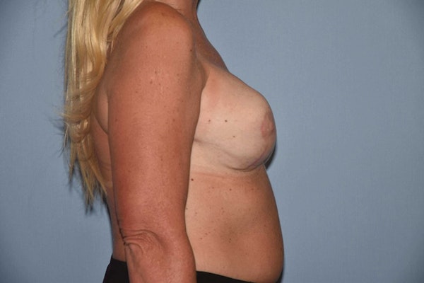 Breast Revision Before & After Gallery - Patient 6389739 - Image 6