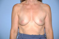 Breast Reconstruction Before & After Gallery - Patient 6389750 - Image 1