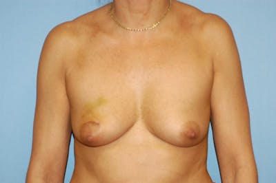 Breast Reconstruction Before & After Gallery - Patient 6389754 - Image 1