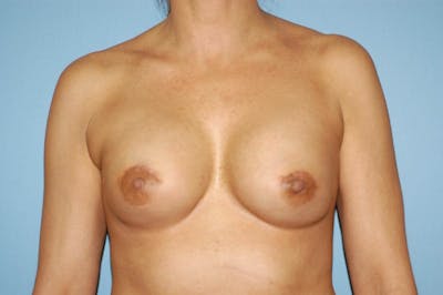 Breast Reconstruction Before & After Gallery - Patient 6389754 - Image 2