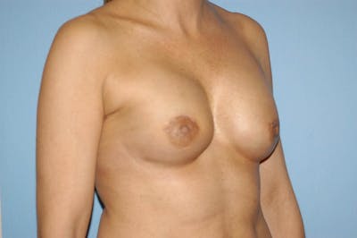 Breast Reconstruction Before & After Gallery - Patient 6389754 - Image 4