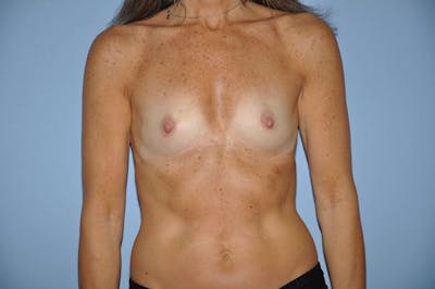Breast Reconstruction Before & After Gallery - Patient 6389758 - Image 1