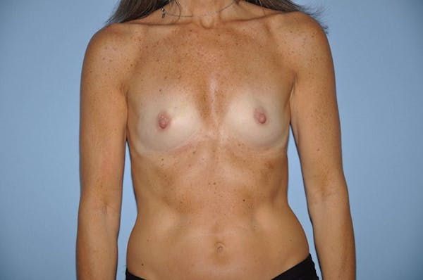 Breast Reconstruction Before & After Gallery - Patient 6389758 - Image 1