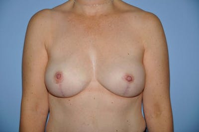 Breast Reconstruction Before & After Gallery - Patient 6389759 - Image 2