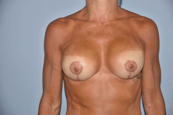 Breast Reconstruction Gallery - Patient 14281739 - Image 2