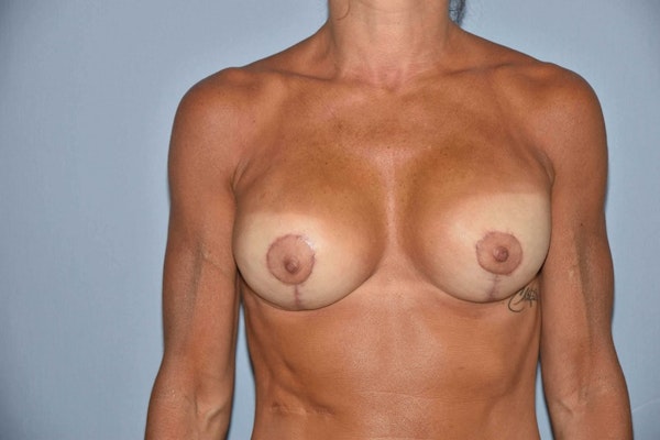 Breast Reconstruction Before & After Gallery - Patient 14281739 - Image 2