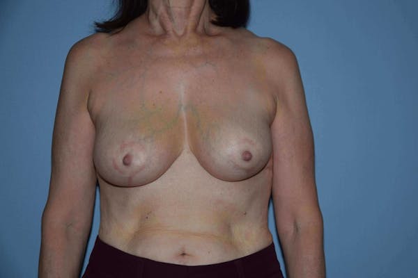 Breast Reduction Before & After Gallery - Patient 6389829 - Image 2