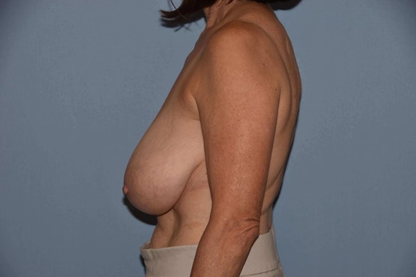Breast Reduction Before & After Gallery - Patient 6389829 - Image 7