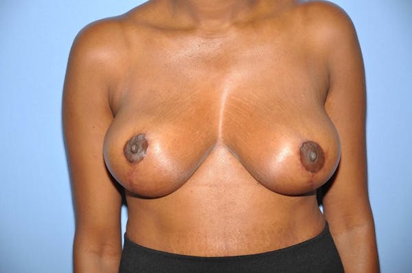 Breast Reduction Gallery - Patient 6389835 - Image 2