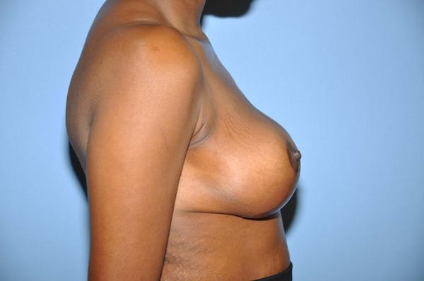 Breast Reduction Gallery - Patient 6389835 - Image 6