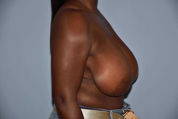 Breast Reduction Before & After Gallery - Patient 6389837 - Image 3