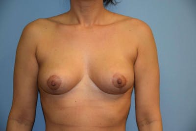 Breast Reduction Before & After Gallery - Patient 6389840 - Image 2