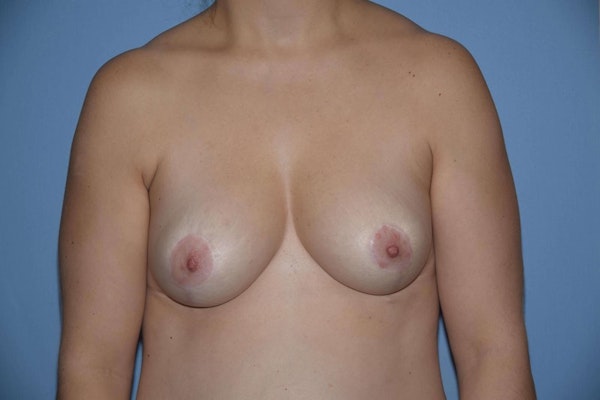 Breast Reduction Before & After Gallery - Patient 6389845 - Image 2