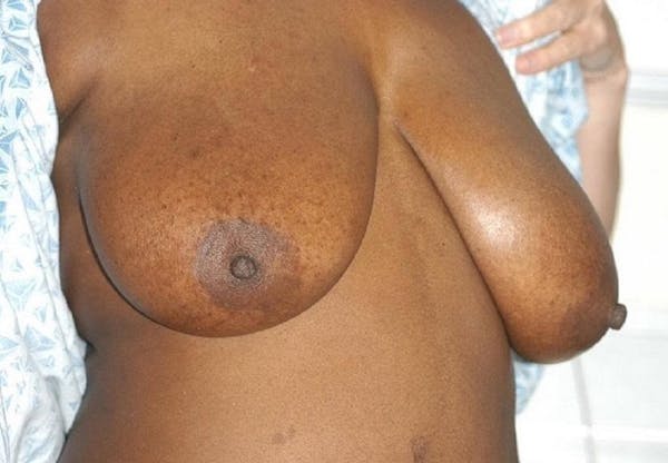 Breast Reduction Gallery - Patient 6389847 - Image 3
