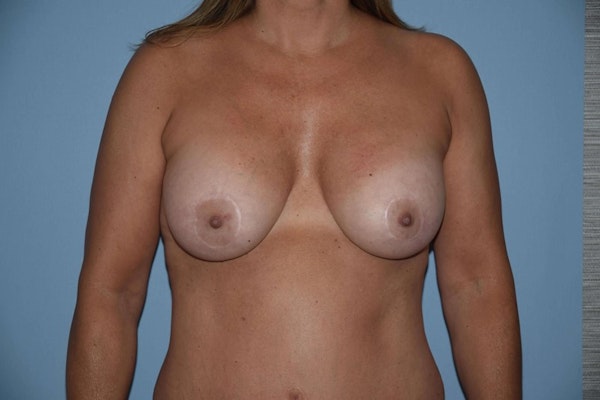 Breast Augmentation + Lift