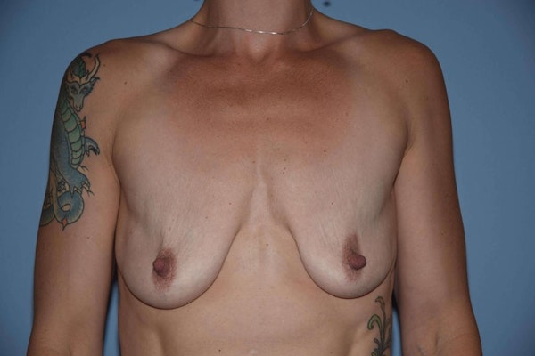 Breast Augmentation Lift Before & After Gallery - Patient 6389857 - Image 1