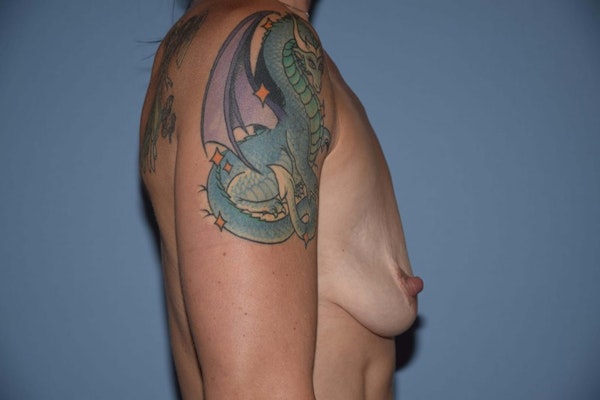 Breast Augmentation Lift Before & After Gallery - Patient 6389857 - Image 5