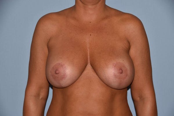 Breast Augmentation Lift Gallery - Patient 6389859 - Image 2