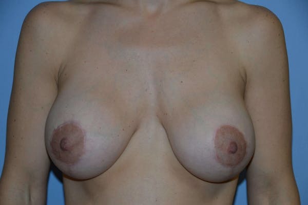 Breast Augmentation Lift Before & After Gallery - Patient 6389870 - Image 2