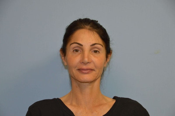 Facelift Before & After Gallery - Patient 6389906 - Image 1