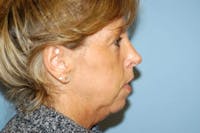 Facelift Before & After Gallery - Patient 6389914 - Image 1