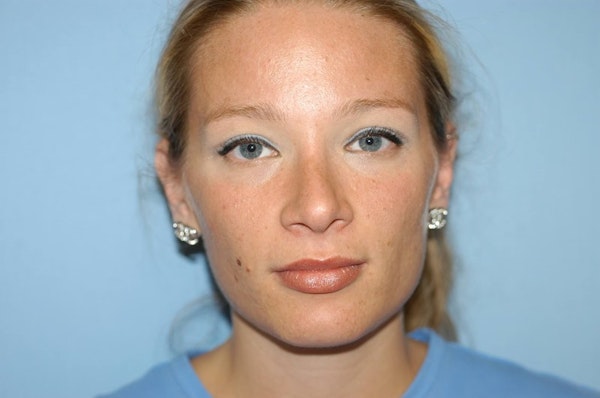 Rhinoplasty Before & After Gallery - Patient 6389943 - Image 4