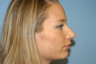 Rhinoplasty Before & After Gallery - Patient 6389943 - Image 1