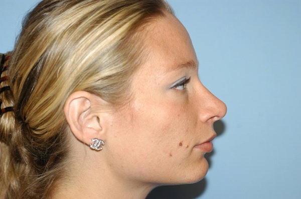 Rhinoplasty Before & After Gallery - Patient 6389943 - Image 2