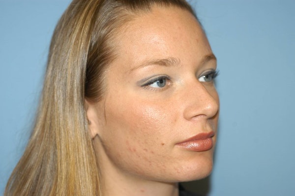Rhinoplasty Before & After Gallery - Patient 6389943 - Image 5