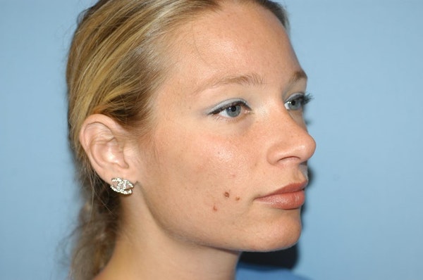 Rhinoplasty Before & After Gallery - Patient 6389943 - Image 6