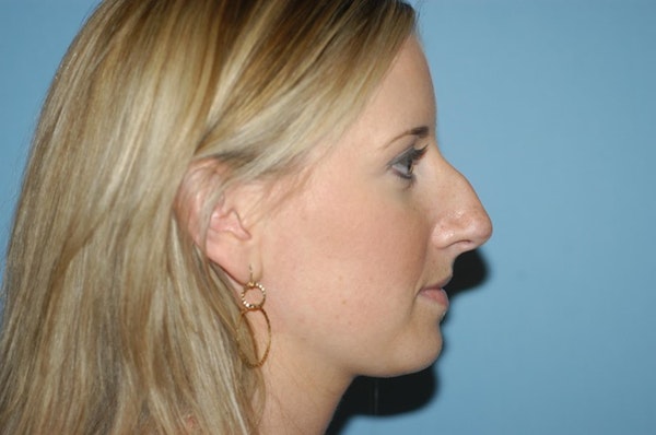 Rhinoplasty Before & After Gallery - Patient 6389945 - Image 1