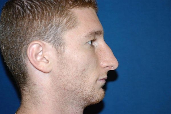 Rhinoplasty Before & After Gallery - Patient 6389946 - Image 1
