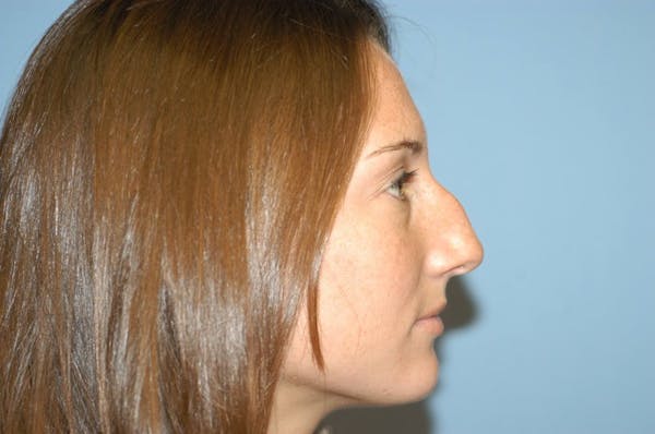 Rhinoplasty Before & After Gallery - Patient 6389949 - Image 3