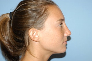 Rhinoplasty