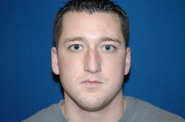 Rhinoplasty Before & After Gallery - Patient 6389962 - Image 3