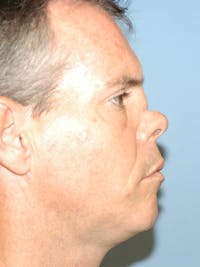 Rhinoplasty Before & After Gallery - Patient 6406137 - Image 1