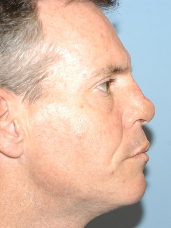 Rhinoplasty Before & After Gallery - Patient 6406137 - Image 2