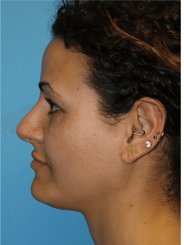 Rhinoplasty Before & After Gallery - Patient 14281849 - Image 2