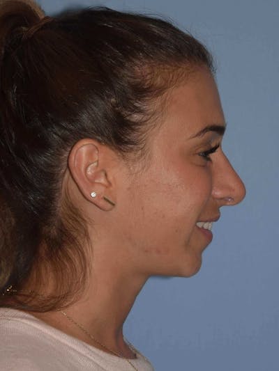 Rhinoplasty Before & After Gallery - Patient 14281850 - Image 2