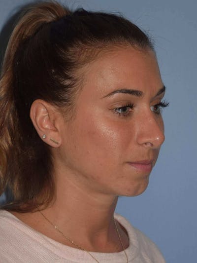 Rhinoplasty Before & After Gallery - Patient 14281850 - Image 4