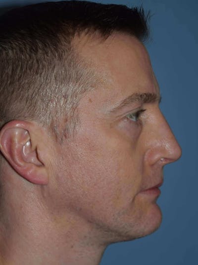Rhinoplasty Before & After Gallery - Patient 14281853 - Image 2