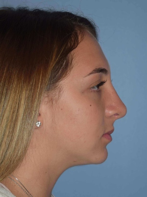 Rhinoplasty Before & After Gallery - Patient 6406146 - Image 2