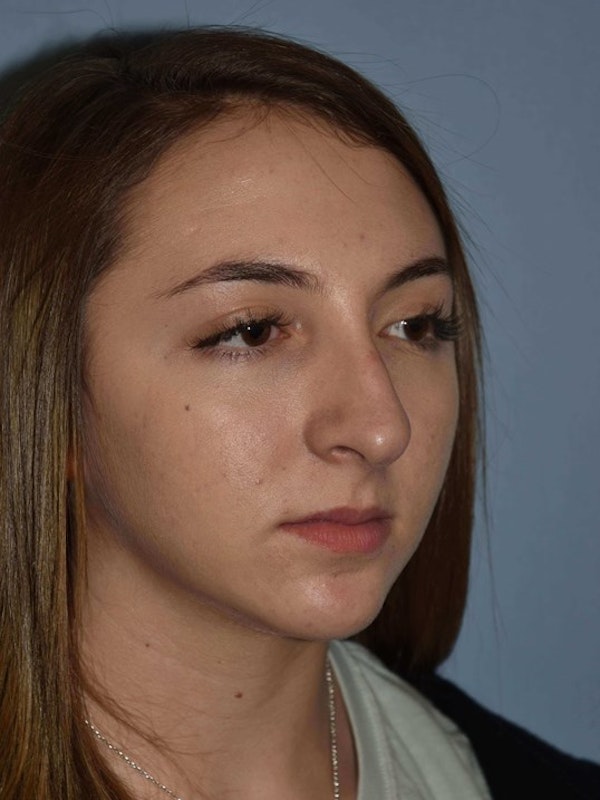 Rhinoplasty Before & After Gallery - Patient 6406146 - Image 3