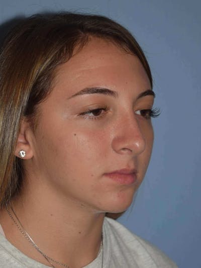 Rhinoplasty Before & After Gallery - Patient 6406146 - Image 4