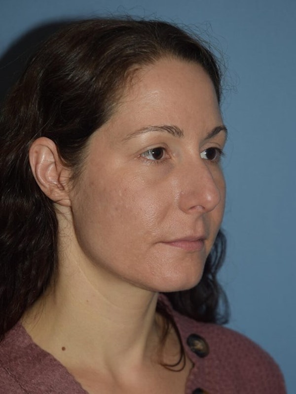 Rhinoplasty Before & After Gallery - Patient 14281861 - Image 3
