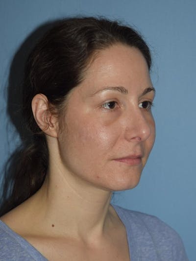 Rhinoplasty Before & After Gallery - Patient 14281861 - Image 4
