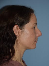 Rhinoplasty Before & After Gallery - Patient 14281861 - Image 1